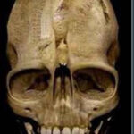 cranioet thumb25255B125255D 1