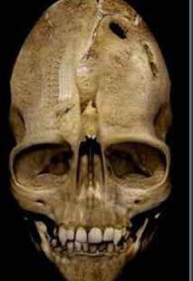 cranioet thumb25255B125255D 1