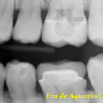 implante alienigena dentes
