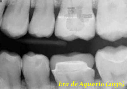 implante alienigena dentes