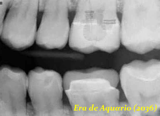 Tecnologia misteriosa é descoberta implantada no dente de um homem 2 implante alienigena dentes